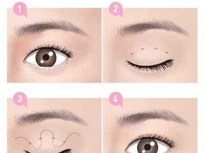 埋线双眼皮的方法如下 埋线双眼皮的方法如下 埋线双眼皮的方法