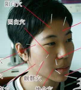 面瘫的自我治疗方法 面瘫(吊斜风)治疗