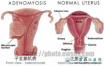 子宫腺肌瘤影响怀孕吗 小腺肌瘤影响怀孕吗？