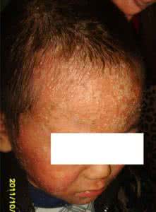 头部上火的症状有哪些 头部上火的症状有哪些 头部牛皮癣有哪些症状呢？