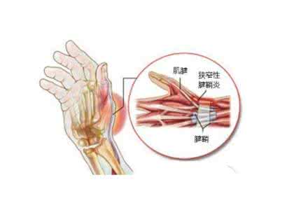 腱鞘炎是什么症状 微信打飞机会得腱鞘炎？腱鞘炎又是什么？
