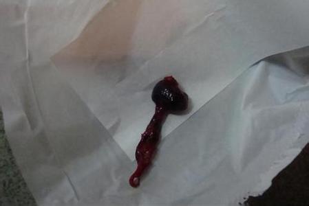 导致自然流产的原因 自然流产时的症状