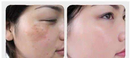 女人祛斑 脸上怎么祛斑 女人脸上有斑【揭秘】什么祛斑产品祛斑效果最好