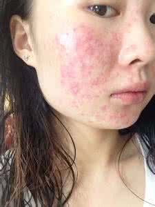 皮肤过敏长痘痘图片 皮肤过敏长痘痘怎么办