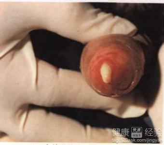 孕妇尿道感染能自愈吗 孕妇尿道感染的症状