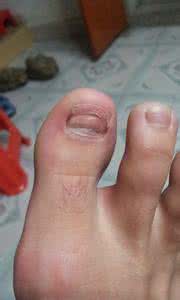 大母脚趾指甲掉完脱落 脚趾甲脱落 脚趾甲掉了 脚趾甲脱落了怎么办