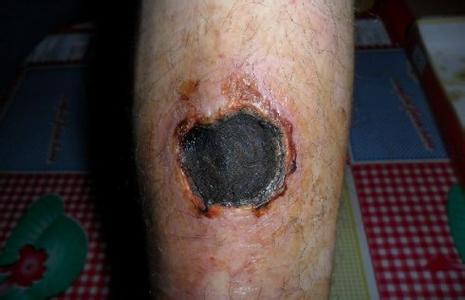 治疗动脉硬化最好偏方 除动脉硬化斑块方法 【 草根一生】