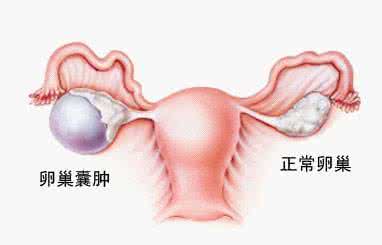 卵巢囊肿的症状 卵巢囊肿症状 正确认识这些症状