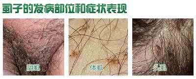 怎样有效的去除阴虱病 盘点治疗阴虱病的有效治疗措施