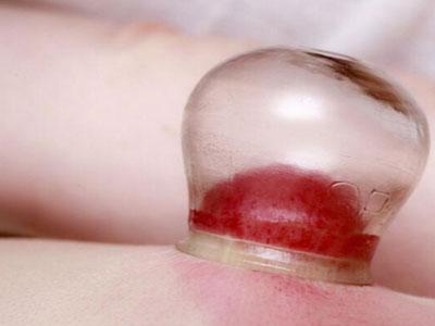 拔火罐会出血吗 拔火罐会出血吗 拔罐会出血吗？