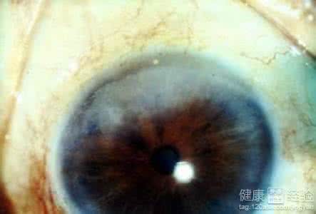 麻风病症状 麻风性角膜病变的症状 4大症状你了解多少