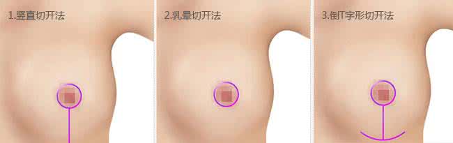 巨乳缩小整形价钱 巨乳整形 巨乳缩小手术效果到底怎么样