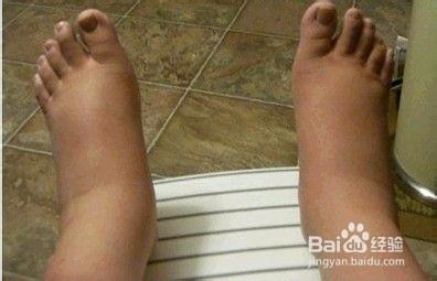 尿毒症有什么症状 尿毒症有什么症状 尿毒症的症状