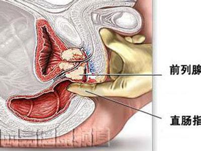 慢性前列腺炎症状表现 慢性前列腺炎症状表现 前列腺炎症状 男人患上前列腺炎有什么表现