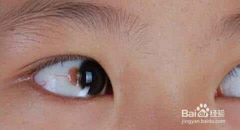 维生素b12缺乏症 维生素b12缺乏症症状 吃素30多年 八旬老太得了维生素B12缺乏症