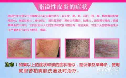 缺乏维生素b2的症状 缺乏维生素b2的症状 宝宝缺乏维生素B2怎么办？缺乏维生素B2的症状