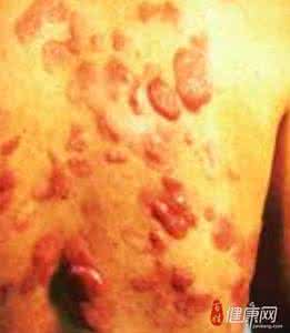 血管肉瘤治疗 血管肉瘤 如何治疗血管肉瘤