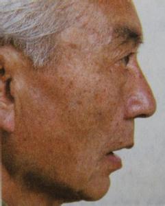 云南白药去老年斑 云南白药酒搽去老年斑