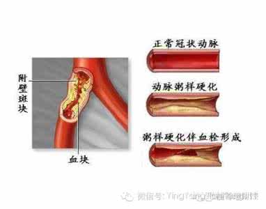 清理血管壁的好方子 (13)清理血管壁的好方子;