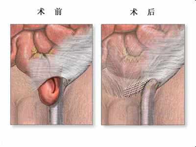 股疝修复术 腹股沟 腹股沟疝修复术