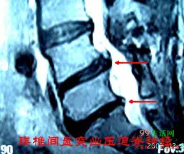 流传百年的羊汤秘方下 【民间秘方】民间流传的腰椎间盘突出症方，一副就好！