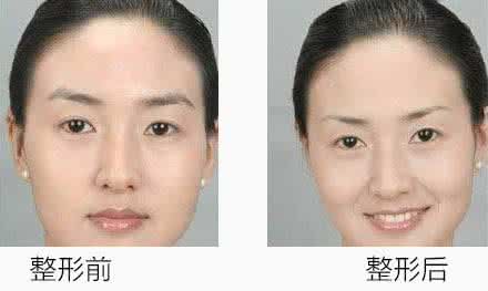 填充眉弓 眉弓填充 隆眉弓的填充方法是什么?