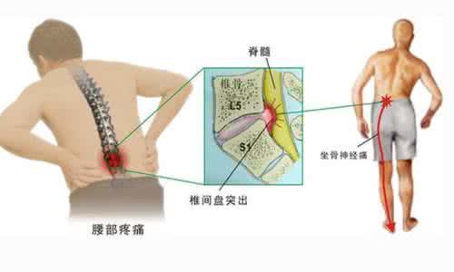 腰突的最佳治疗方法 腰椎间盘突出治疗方法 正确方法治疗腰突