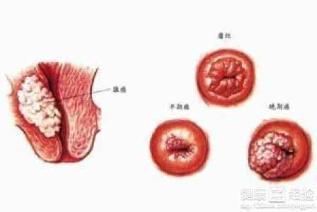 宫颈癌可以治愈吗 宫颈癌可以治愈吗 宫颈癌是否可以治好