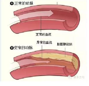 血管壁血栓斑块咋清理 血栓和斑块治疗 血管斑块血栓如何治疗，血管斑块血栓吃什么