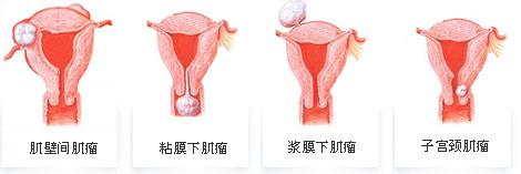 子宫肌瘤常见症状 子宫肌瘤常见症状是什么