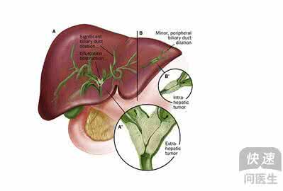 胆管癌早期症状 胆管癌 早预防早治疗胆管癌