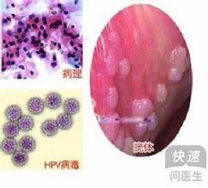 性病如何治疗 男士性病应如何治疗