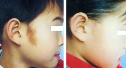 激光去胎记会不会有疤 激光去胎记会不会有疤 激光去除胎记会不会疼