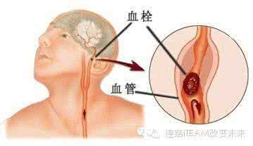 脑梗塞的症状及治疗 脑梗症状 这些症状的出现就是脑梗