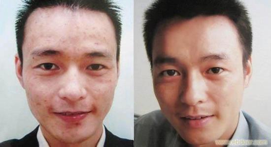 治青春痘痤疮的中医 摆脱青春痘 中医外治痤疮有良方