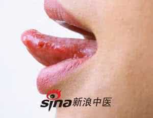 口腔溃疡食疗方 上火口腔溃疡怎么办?推荐三大食疗方