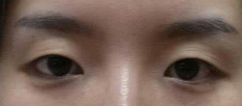 戴眼镜眼角下垂 戴眼镜眼角下垂 戴眼镜眼皮下垂怎么办呢?