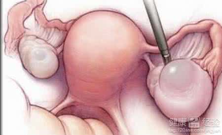 子宫有囊肿怎么办 子宫囊肿 子宫囊肿怎么办