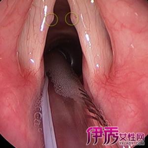 咽喉息肉的症状 咽喉息肉 咽喉息肉的症状与治疗