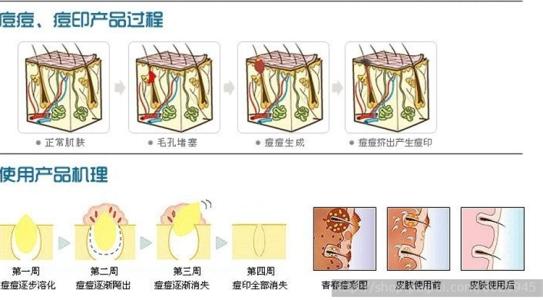 头皮屑是怎么形成的 头皮屑是如何形成的及预防的主要方法？