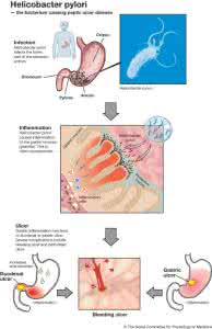 幽门螺杆菌阳性治疗 治幽门螺杆菌阳性消化性溃疡方