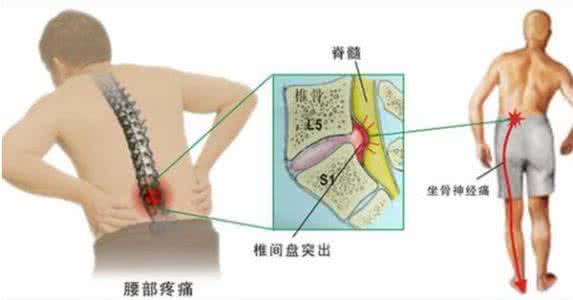 腰椎间盘突出腰肌劳损 腰痛！腰椎间盘突出还是腰肌劳损？