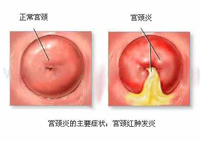 慢性宫颈炎病因是什么 慢性宫颈炎病因是什么 宫颈炎的病因是什么