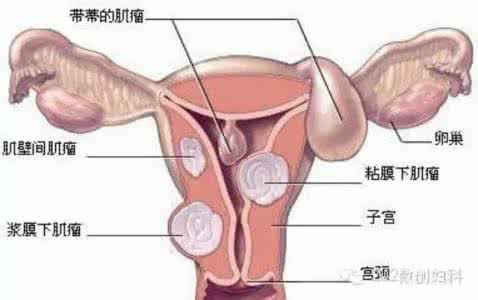 子宫肌瘤手术注意事项 子宫肌瘤手术后注意事项 子宫肌瘤术后保养