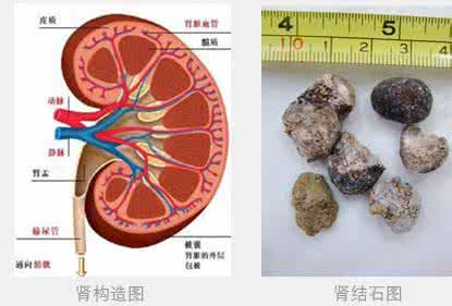 肾结石多大需要手术 常见6大肾结石手术大盘点