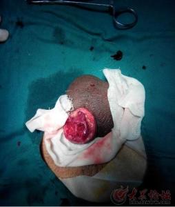 切包茎手术 包皮 做包皮