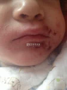 口角炎的原因及治疗 小儿口角炎怎么治 小儿口角炎怎么去治疗
