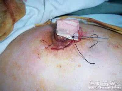 不手术治疗乳腺纤维瘤 乳腺纤维瘤治疗需要手术吗