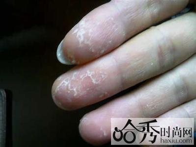 手脚干燥怎么办小偏方 手脚脱皮小偏方 8个偏方缓解手脚脱皮 做精致女人