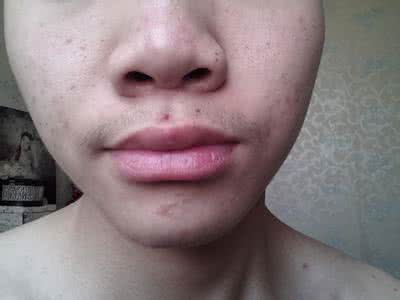 背后长痘痘涂什么药 背后长痘痘用什么药?